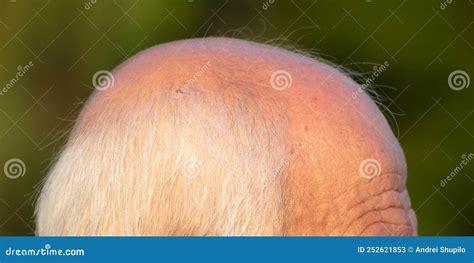 A Man With Baldness On His Head During The Procedure With The Darsonval