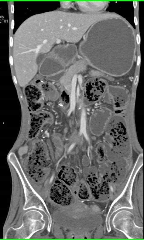 Dilated Small Bowel With Obstruction In A Patient With Prior Bowel