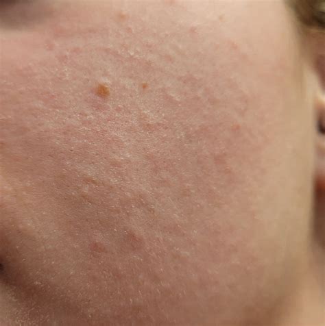 [skin concern] how to get rid of these little bumps all over my face skincareaddiction