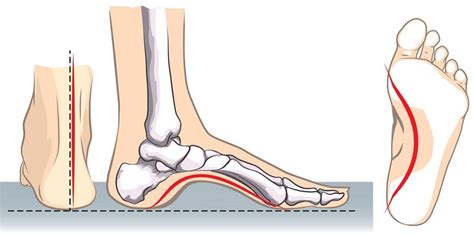 High Arches Problems How To Relieve Foot Arch Pain