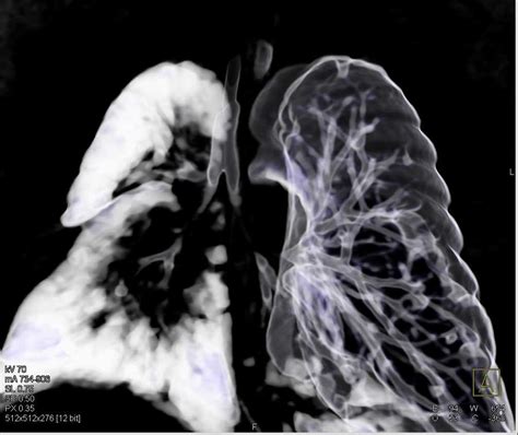 Hypoplastic Right Lung Chest Case Studies Ctisus Ct Scanning