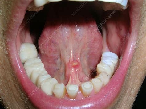 Mucocele Under Tongue Stock Image C056 4885 Science Photo Library