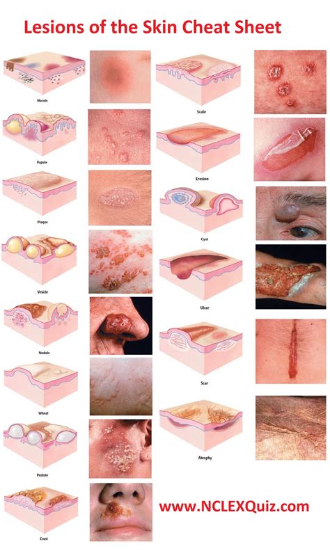Nursing Dermatology Lesions Of The Skin Cheat Sheet For Nclex A Skin Lesion Is A Part Of The