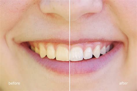 White Spots On Teeth After Braces Causes How To Fix Orthodontic