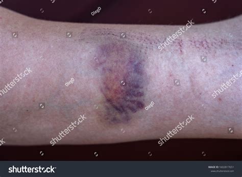 Purple Bruise On Skin On Woman Stock Photo 1602817651 Shutterstock