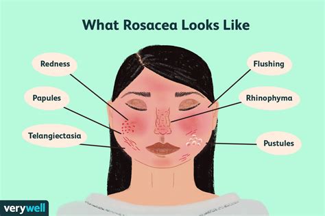 Rosacea What It Looks Like Causes And Treatment