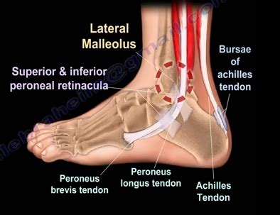 Peroneal tendonitis occurs when the peroneal tendons become inflamed. Everything You Need To Know About Ankle Pain And Ankle ...