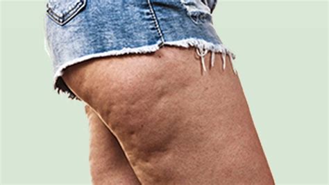 Does Collagen Help With Cellulite Flab Fix