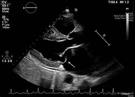 Flail Of Posterior Mitral Leaflet White Arrow Download Scientific