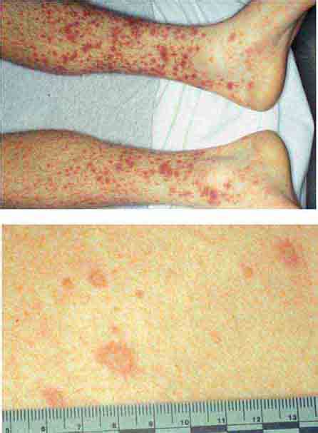 Atlas Of Rashes Associated With Fever Basicmedical Key