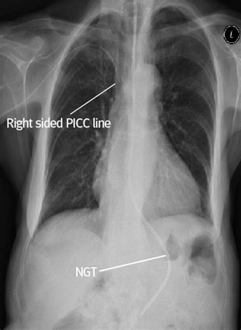 Interpreting Lines And Tubes On Radiographs The Bmj