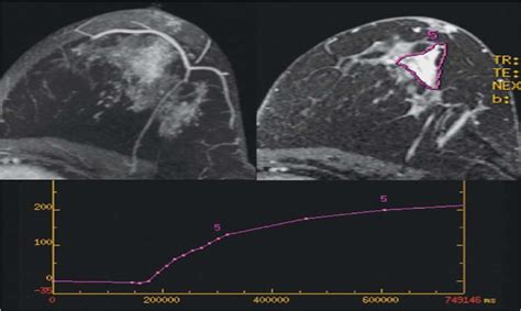 Concordant Or Discordant Radiologic Pathologic Correlation