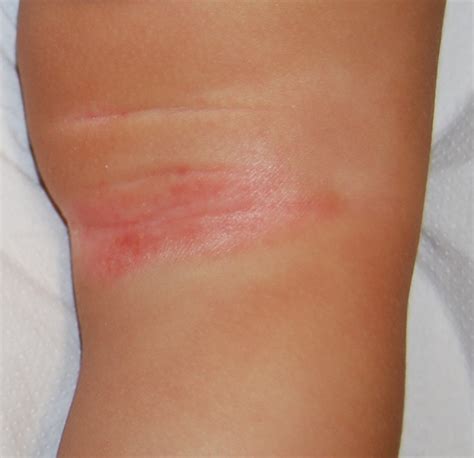 Inverse Psoriasis From Diagnosis To Current Treatment Options