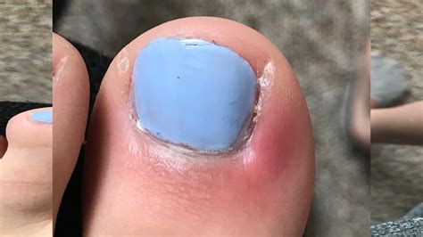 Top 168 Toe Infection From Nail Salon Architectures Eric