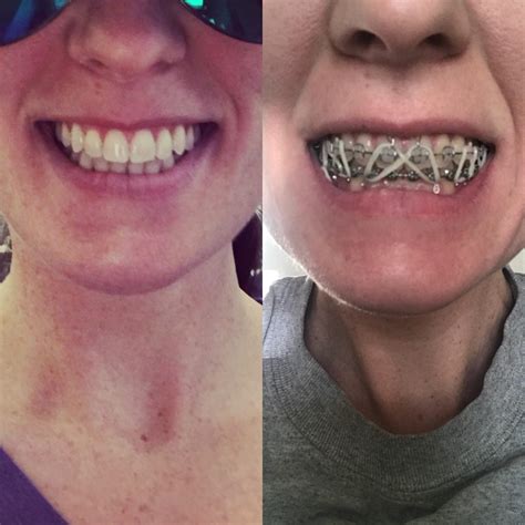 18 Images Luxury Face Change Before And After Braces