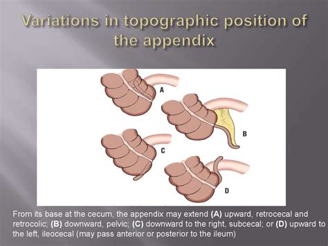 Clinical Anatomy And Operative Surgery Of Appendicitis Online