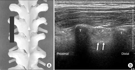Ultrasound Guided Intervention In Thoracic Spine
