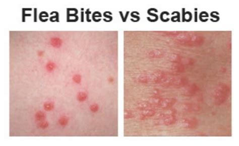 Flea Bites Vs Bed Bug Bites Pictures Difference How To Tell
