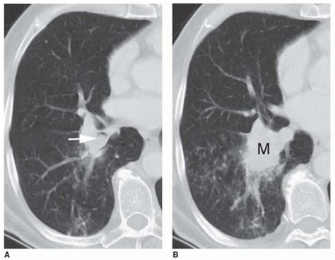 Lung Cancer And Bronchopulmonary Neoplasms Radiology Key