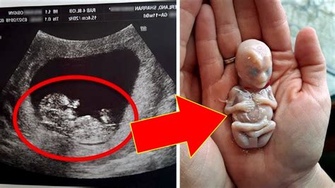 6 Weeks After This Mother Gave Birth Doctors Found A Deadly Unborn