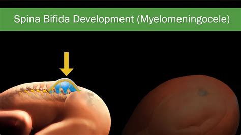 Fetal Spina Bifida Comprehensive Guide On Diagnosis Treatment