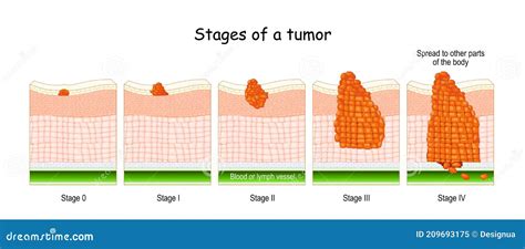 Stages Of Cancer Classification Of Malignant Tumours Cartoon Vector