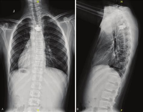 A And B Posteroanterior And Lateral X Ray Image Of The Thoracic Spine