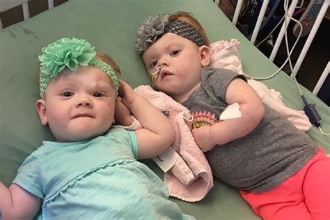 Formerly Conjoined Twins Thrive Months After Surgery