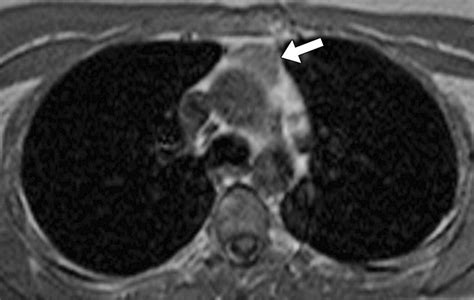 Usefulness Of Ct In Differentiating Lymphoid Thymic Hyperplasia From