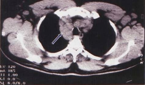 A Ct Scan Chest Before Chemotherapy Download Scientific Diagram