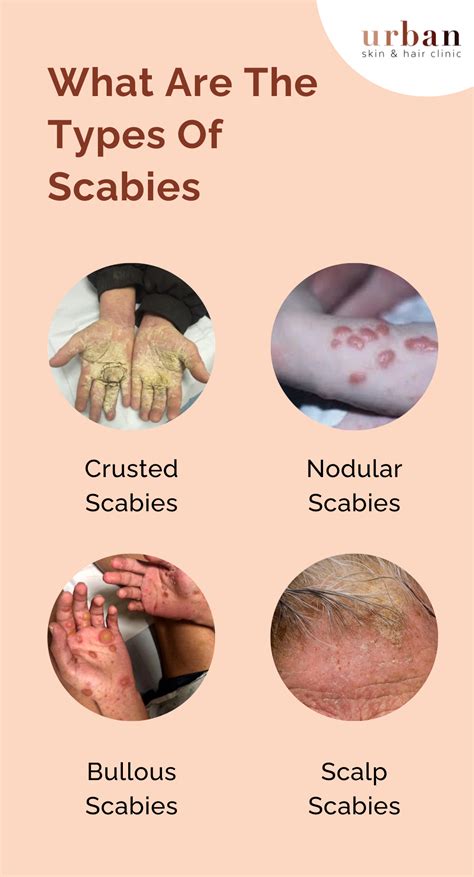 Scabies Types Causes Symptoms Treatment USHC