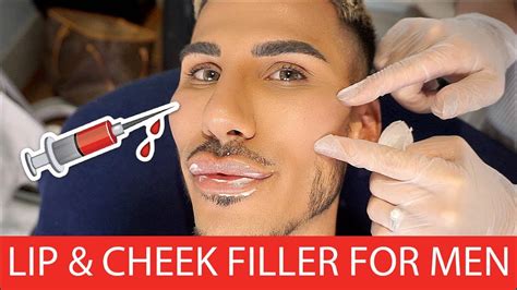 Lip And Cheek Filler For Men Flawless Cosmetic Youtube