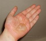 Pictures of Fingernail Eczema Treatment