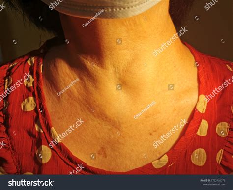 Anterior Neck Swelling Known Medically Goitre Stock Photo 1762402076