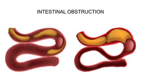 Bowel Obstruction Gbmc Jordan