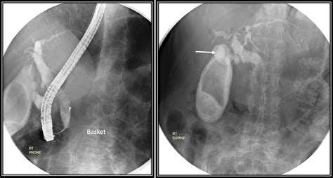 Endoscopic Removal Of Choledocholithiasis Radiology Cases