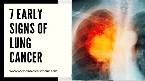 Early Signs Of Lung Cancer Medical Blog For Students