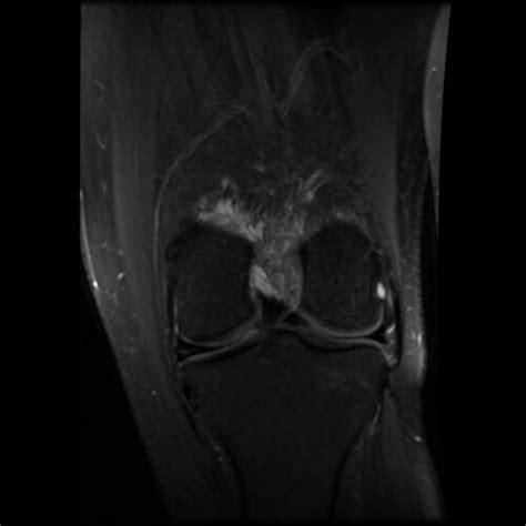 Sculptor / painter kelly borsheim's blog: Houston Texas MRI or Magnetic resonance imaging Of my torn ACL in my Left Knee 2009 Photos ...