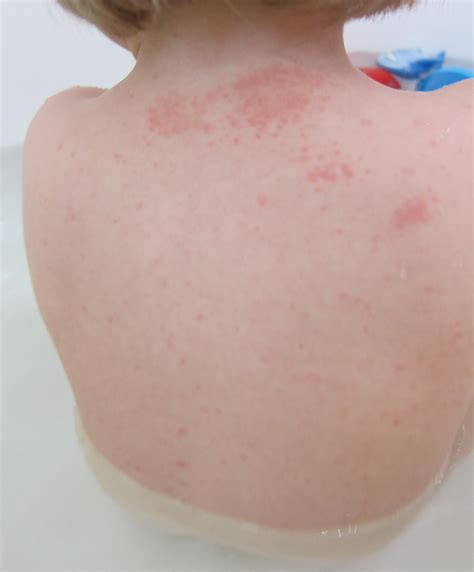 Small Circular Rash Pictures Photos