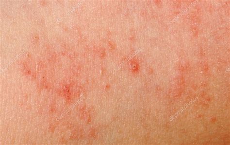 Allergic Rash Dermatitis Skin Texture — Stock Photo © Panxunbin 6947069