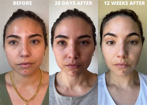 Cheek Fillers My Experience Getting Injections With Before After Photos Lauryncakes