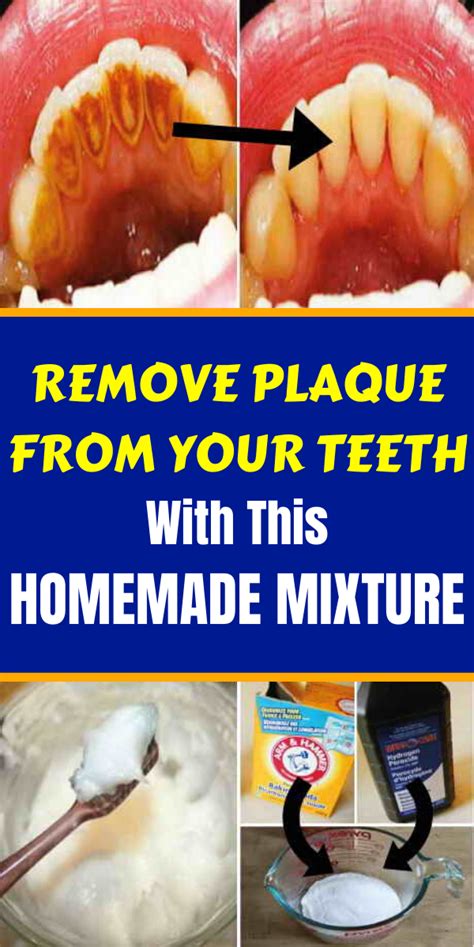 How do you prevent black teeth? Wellness Tips: Remove Plaque From Your Teeth With This ...