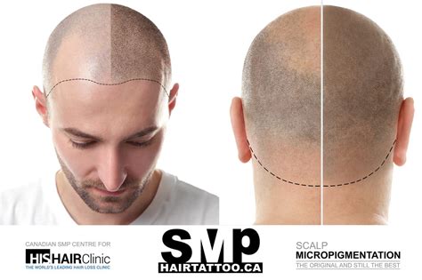 What Is Scalp Micropigmentation Revisedhtml276a89ef4fcba171 The