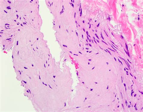Pathology Outlines Amyloidosis