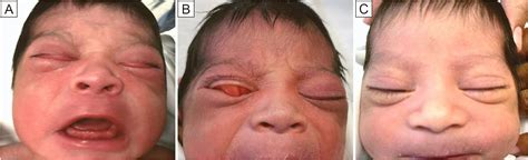 Congenital Eyelid Imbrication Syndrome In A Hispanic Newborn Case