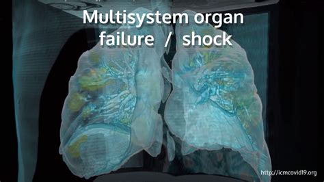 Multi System Organ Failure Shock Integrated Crisis Management Covid 19