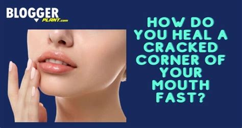 Homeopathic Remedy For Cracks In Corner Of Mouth