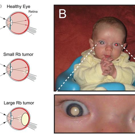 Leukocoria In Children With Retinoblastoma A The Reflection Of
