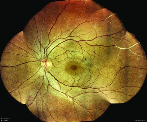 Mosaic Colour Fundus Photograph Of Left Eye Showing Multiple Occlusions