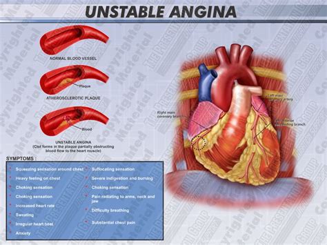 Vasospastic angina (prinzmetal variant angina). 10 best images about stable unstable prinzmetal angina on ...